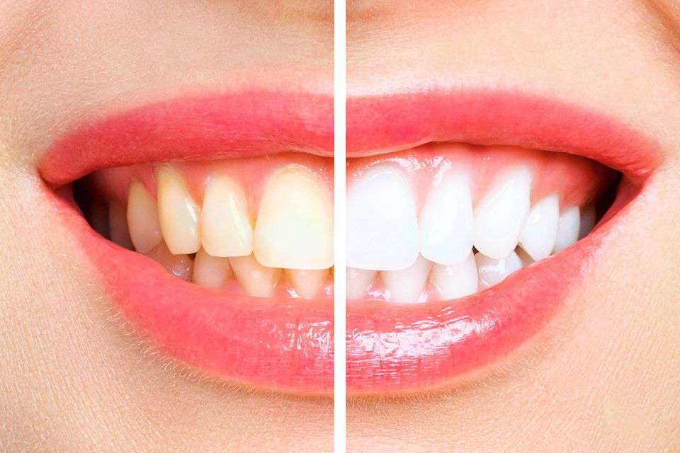 Teeth Whitening