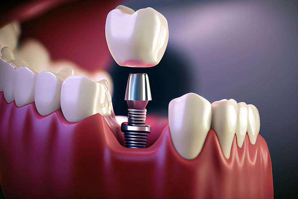 Dental Implants