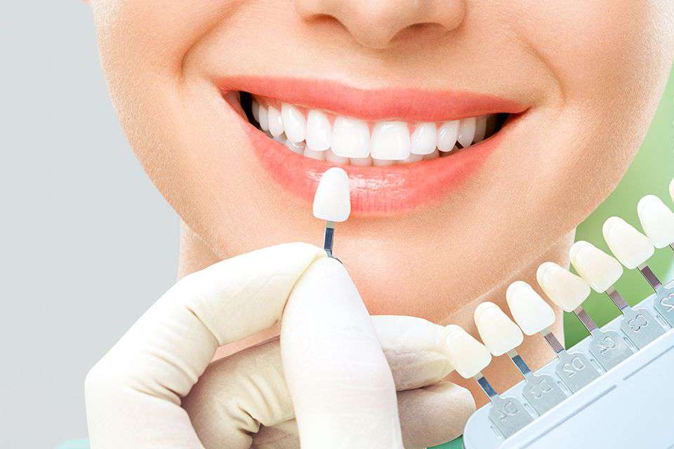 Porcelain Veneers – Emax