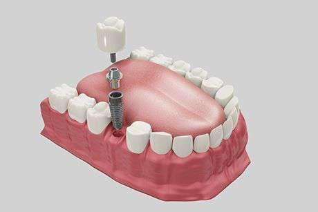 Prosthodontics